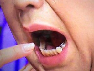マツコの歯列矯正器具画像